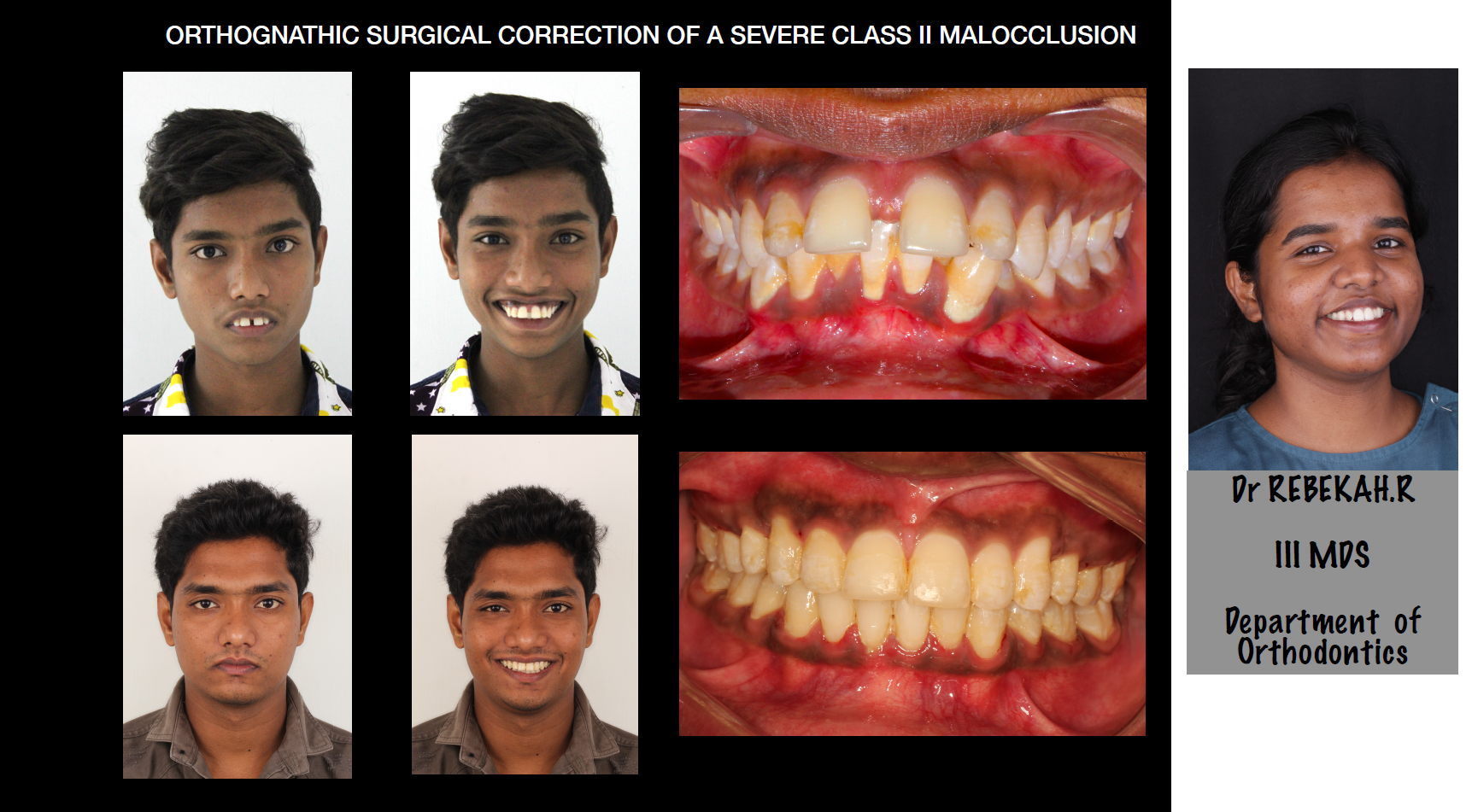 健康・医学 269 Class III Correction Orthodontics A CASE OF SEVERE PROCLINATION AND RETROGNATHIC MANDIBLE CORRECTED